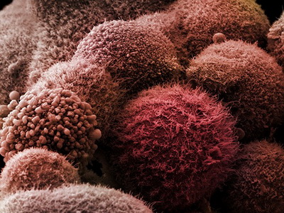 О лечении рака яичников